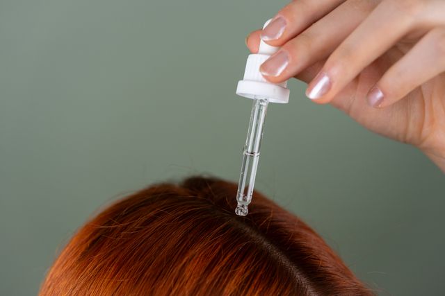 Minoxidil: Beneficii si 6 Limite De Care Trebuie Sa Stii