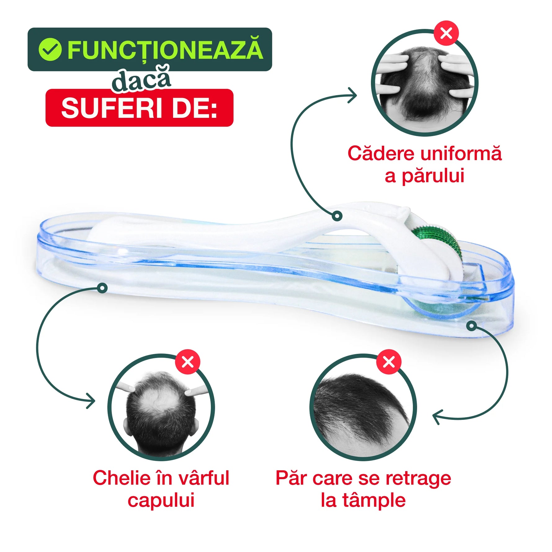 Derma roller tratament pentru căderea părului – soluție pentru chelie și păr care se retrage la tâmple.